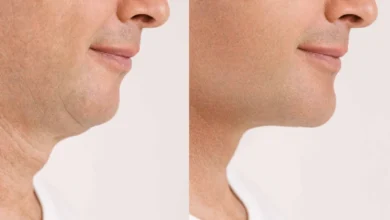 Neck Lift in Dubai