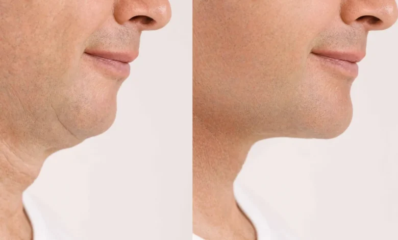 Neck Lift in Dubai
